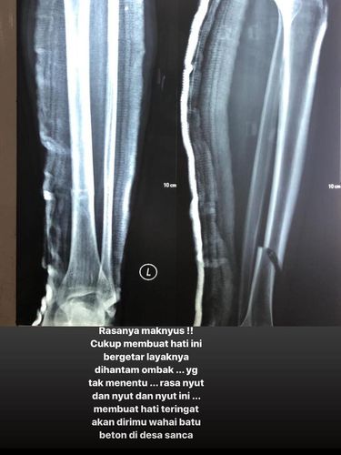 GAMBAR KAKI SAMMY SIMORANGKIR