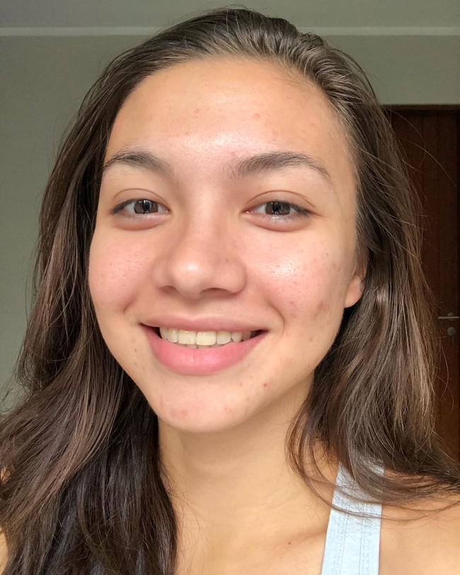 Jerawat dan bekas jerawatnya terpampang nyata. Angela pun memperlihatkan giginya yang kuning. Unggahannya tersebut diakuinya sebagai bentuk penerimaan atas dirinya sendiri.  Foto: dok. Instagram