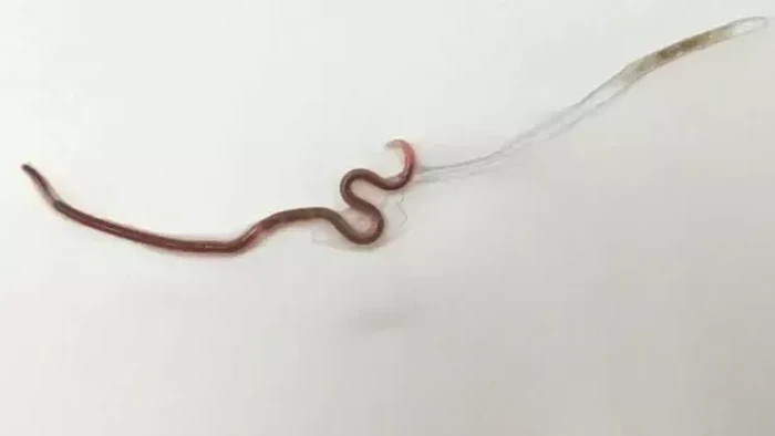 Eks Pejabat WHO Ikut Soroti Kasus Cacingan di Balita Sukabumi, Wanti-wanti Ini