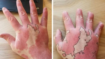 Tanda lahir yang jika disambung jadi gambar peta dunia. Foto: Boredpanda