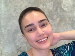 Kisah Feby Febiola Jalani Pengobatan Kista Ovarium Hingga Rambut Jadi Bondol