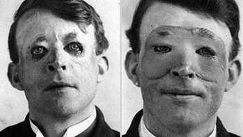 Pada foto ini adalah Walter Yeo di tahun 1917. Dia menjalani operasi plastik yang dinamakan skin flap. Operasi ini dilakukan untuk menyembunyikan luka akibat perang yang mengerikan. Namun agak sulit membedakan mana kondisi sebelum dan sesudah operasi pada foto ini. Foto: via Daily Forest