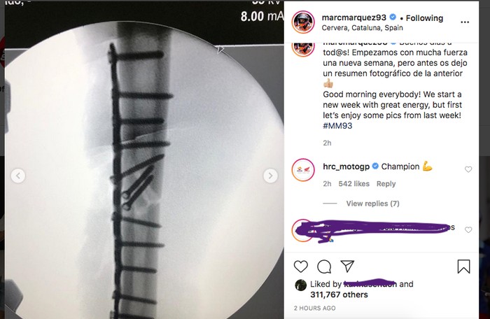 Cedera patah tulang Marc Marquez