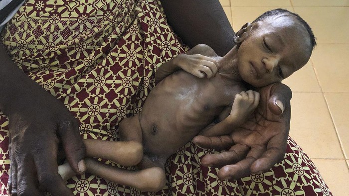 Corona Bikin Anak-anak di Burkina Faso Makin Menderita One-month old Haboue Solange Boue sits on the lap of her mother Danssanin Lanizou, 30, right, as a nurse inserts an intravenous drip into her arm to treat her for severe malnutrition at the feeding center of the main hospital in the town of Hounde, Tuy Province, in southwestern Burkina Faso on Thursday, June 11, 2020. All around the world, the coronavirus and its restrictions are pushing already hungry communities over the edge, cutting off meager farms from markets and isolating villages from food and medical aid. (AP Photo/Sam Mednick)