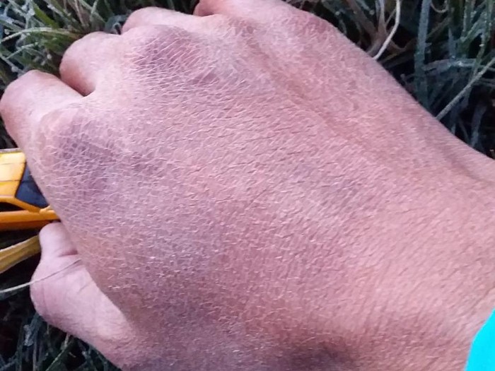 kondisi kulit akibat embun es di dieng kondisi kulit akibat embun es di dieng