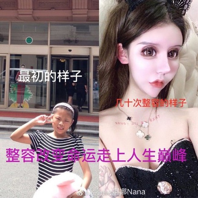 Nana mengungkapkan di akun Weibo alasannya menjalani operasi plastik berkali-kali. Nana mengaku dia tidak merasa cantik dan ingin mengubah penampilannya. Setelah satu kali operasi, dia jadi kecanduan bedah plastik. Foto: Dok. Weibo Little Z Nana
