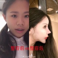 Dalam foto before after yang diunggahnya ke media sosial, wanita yang dikenal dengan panggilan Nana itu tampak sangat berbeda sebelum operasi plastik. Netizen sungguh kaget melihat wajah asli Nana. Foto: Dok. Weibo Little Z Nana
