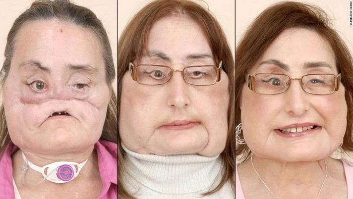 Connie Culp Connie Culp, pasien transplantasi wajah pertama di Amerika Serikat meninggal dunia.