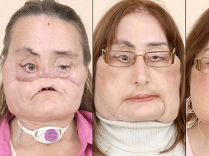 9 Tahun Bertahan Hidup, Pasien Transplantasi Wajah Pertama AS Meninggal