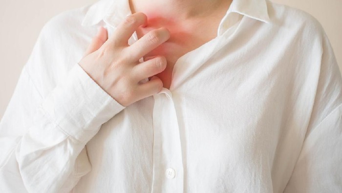 Biang Keringat Terasa Gatal dan Mengganggu, Gimana Mengatasinya Dok?