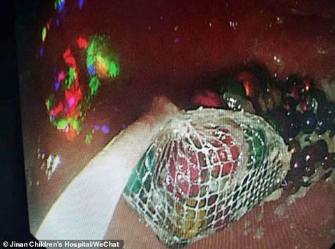 Anak kecil menelan bola magnet Anak kecil menelan bola magnet