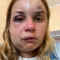 Presenter TV Rusia Anastasia Lugova menceritakan kisah pilunya saat menjadi korban perkosaan di kereta. Dalam kejadian tersebut, wanita 28 tahun itu juga dipukuli sampai wajahnya babak belur.  Foto: dok. Facebook