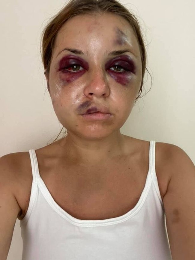 Beginilah wajah babak belur Anastasia saat hampir diperkosa oleh pria kejam itu. Anastasia berusaha melarikan diri ketika si pelaku melucuti bajunya.  Foto: dok. Facebook