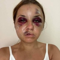 Beginilah wajah babak belur Anastasia saat hampir diperkosa oleh pria kejam itu. Anastasia berusaha melarikan diri ketika si pelaku melucuti bajunya.  Foto: dok. Facebook