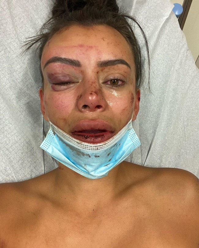 Bintang reality show cantik Yasmine Pierards membagikan foto-foto dengan wajah babak belur di Instagram. Wajah cantiknya pun berubah menjadi lebam dengan mata bengkak dan biru.  Foto: dok. Instagram