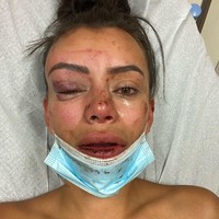 Bintang reality show cantik Yasmine Pierards membagikan foto-foto dengan wajah babak belur di Instagram. Wajah cantiknya pun berubah menjadi lebam dengan mata bengkak dan biru.  Foto: dok. Instagram