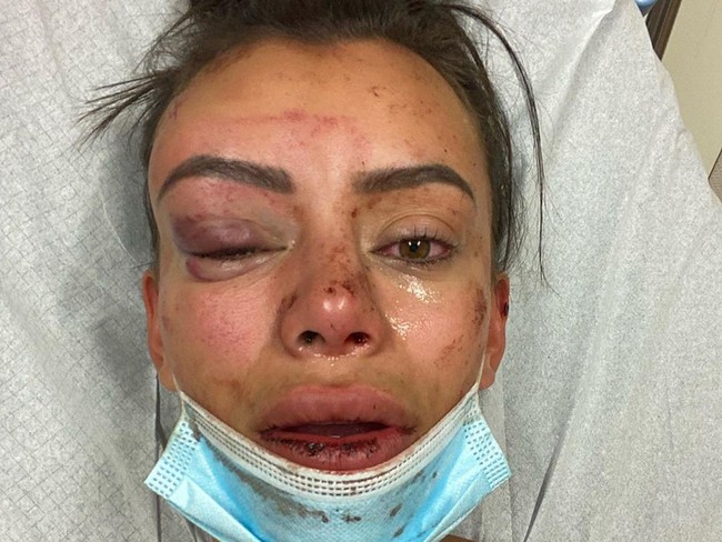 Yasmine mengalami patah tulang hidung dan wajah babak belur setelah di pukul dan ditendang di seluruh tubuhnya. Semua berawal dari Yasmine mengadakan pesta di rumahnya. Setelah pesta usai, masih ada satu orang yang tidak ingin pulang.  Foto: dok. Instagram