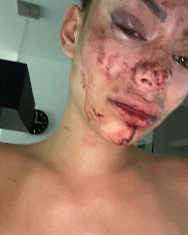 Bintang reality show asal Belgia itu baru saja mengalami tindakan aniaya oleh salah seorang temannya. Dia dipukuli oleh pria tersebut saat mengadakan pesta di rumahnya.  Foto: Instagram