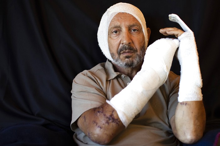 Lebanon Scars Photo Essay This combo of photos taken between Aug. 13 and Aug. 16, 2020, shows people who got injured during the Aug. 4 explosion that killed more than 170 people, injured thousands and caused widespread destruction, pose for a photograph in Beirut, Lebanon. (AP Photo/Hassan Ammar)