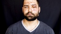 Hassan Nabha (27), seorang insinyur komputer dan komunikasi, yang terluka di kantornya ketika ledakan besar terjadi. Ledakan di Beirut menewaskan lebih dari 170 orang, melukai ribuan orang dan menyebabkan kerusakan parah.  