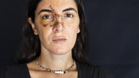 Clara Chammas, psikolog dan pelatih kesehatan, yang terluka di apartemennya saat ledakan besar yang membentuk awan jamur terjadi di Beirut, Lebanon.  