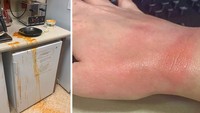 Kecelakaan bisa saja terjadi saat menggunakan microwave. Seperti yang dialami orang ini, tangannya terbakar usai mengambil sup tomat kaleng yang dipanaskan di dalamnya. Foto: Bored Panda