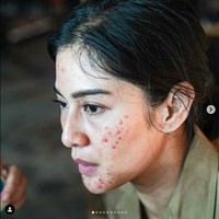 Inilah Dian Sastrowardoyo dengan wajah yang berjerawat parah. Benarkah Dian jerawatan? Melalui unggahan di akun Instagramnya @therealdisastr, Dian mengungkap fakta sebenarnya dari penampilannya yang tampak dihiasi jerawat merah tersebut. Foto: Armαn Febryαn via Instagram @therealdisastr.