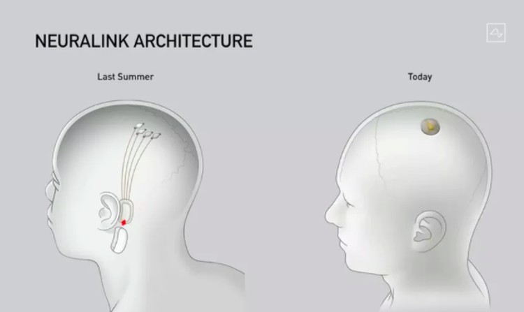 Neuralink Neuralink
