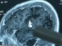 Cacing Bersarang di Otak Pria gegara Telan Empedu Ular