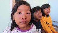 Sejumlah anak menunjukkan luka akibat serangan Semut Semai atau serangga Tomcat (Paederus littoralis) di desa Pabean udik, Indramayu, Jawa Barat, Selasa (1/9/2020). 