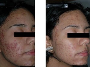 Wanita Ini Dulu Minder Jerawatan Lihat Sekarang