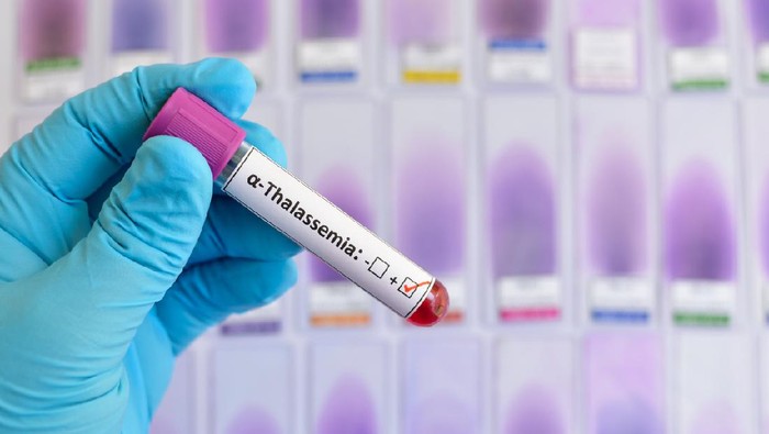 thalassemia Blood sample positive with alpha-thalassemia