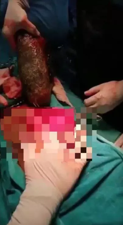 Hobi Ngemil Rambut, Ada 7 Kg Bola Rambut di Perut Remaja Ini
