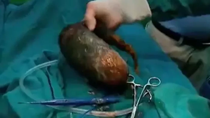 Hobi Ngemil Rambut, Ada 7 Kg Bola Rambut di Perut Remaja Ini