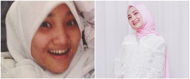 Perbedaan wajah Fatin Sidqia dulu dan sekarang. Menurutmu apa yang berubah dari wajahnya? Foto: Instagram/@fatin30