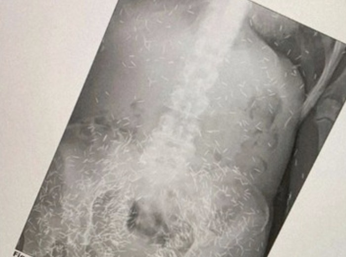 susuk Ratusan susuk yang terlihat melalui Xray