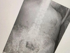 Temuan Susuk Corpus Alienum Ternyata Bukan Barang Langka di Radiologi