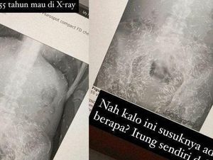 Heboh Susuk Terdeteksi Xray, Ini 5 Pantangan Makan Bagi Pemakai Susuk