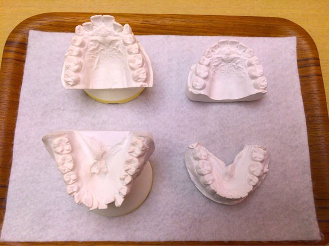 Selain wajah, wanita itu juga memperbaiki gigi hingga wajahnya tampak lebih tirus. Di akun Twitter, ia pun membagikan foto bagaimana struktur giginya berubah. Foto: Twitter @Qpr_7