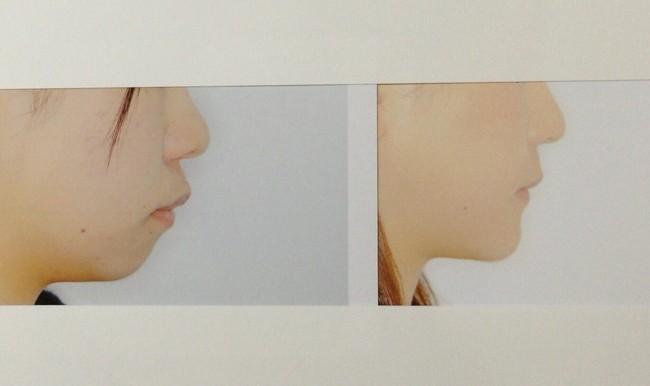 Aku sangat membenci wajahku bahkan aku tidak ingin orang melihat wajahku jadi aku tidak mau berjalan ke luar atau naik kereta. Itu lah mengapa orangtuaku menjemputku dari sekolah dengan mobil, ungkap Mikishi kepada majalah SPA. Foto: Twitter @Qpr_7