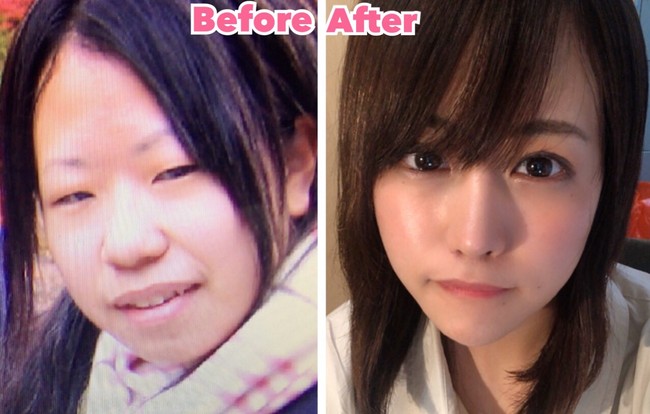 Banyak foto transformasi operasi plastik bikin tercengang karena pelakunya tampak seperti orang yang berbeda. Foto before-after dari wanita bernama Mikishi ini pun membuat terkejut karena perubahannya tidak hanya bikin pangling tapi juga tampak natural. Foto: Twitter @Qpr_7