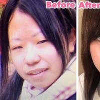 Banyak foto transformasi operasi plastik bikin tercengang karena pelakunya tampak seperti orang yang berbeda. Foto before-after dari wanita bernama Mikishi ini pun membuat terkejut karena perubahannya tidak hanya bikin pangling tapi juga tampak natural. Foto: Twitter @Qpr_7