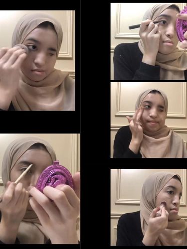 Avirisha Salwa yang mengalami skoliosis