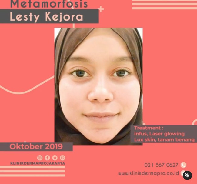 Wajah Lesti kini semakin kinclong, dan tirus. Wajah proporsionalnya itu membuat Lesti menjadi semakin cantik. Foto: Instagram @klinikdermaprojakarta