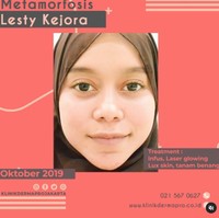 Wajah Lesti kini semakin kinclong, dan tirus. Wajah proporsionalnya itu membuat Lesti menjadi semakin cantik. Foto: Instagram @klinikdermaprojakarta