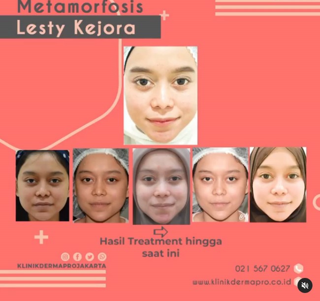 Pada Oktober 2020 ini terungkap Lesti Kejora melakukan sederet perawatan kecantikan yang membuat penampilannya semakin paripurna. Lesti yang berusia 21 tahun melakukan sejumlah prosedur kecantikan mulai dari botox, filler hingga tanam benang. Foto: Instagram @klinikdermaprojakarta