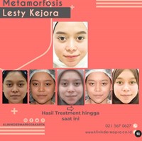 Sebelum ada prosedur tarik benang, metode kecantikan tanam benang pun populer. Lesty Kejora misalnya yang melakukan perawatan tanam benang.  Foto: Instagram @klinikdermaprojakarta