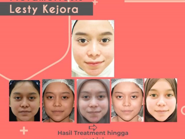 Sebelum ada prosedur tarik benang, metode kecantikan tanam benang pun populer. Lesty Kejora misalnya yang melakukan perawatan tanam benang.  Foto: Instagram @klinikdermaprojakarta