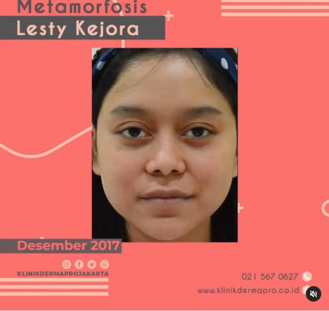 Wajah Lesti kini semakin kinclong, dan tirus. Wajah proporsionalnya itu membuat Lesti menjadi semakin cantik. Foto: Instagram @klinikdermaprojakarta