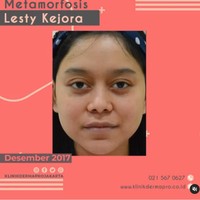 Wajah Lesti kini semakin kinclong, dan tirus. Wajah proporsionalnya itu membuat Lesti menjadi semakin cantik. Foto: Instagram @klinikdermaprojakarta